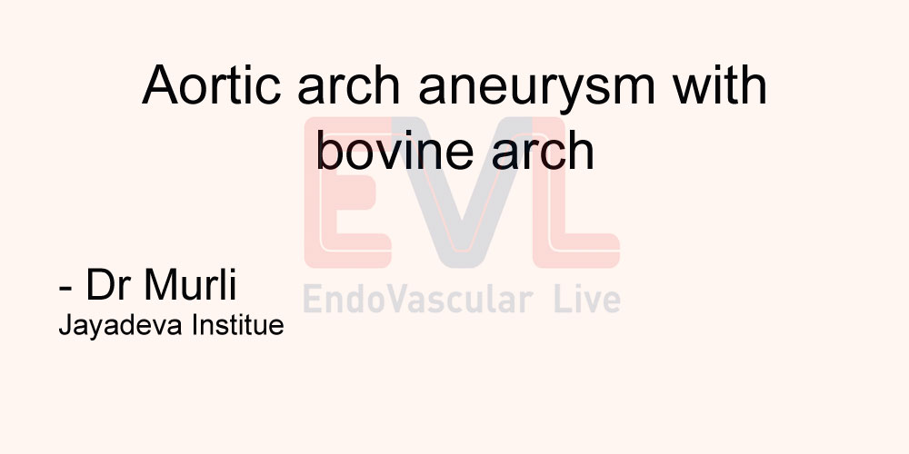 Aortic arch aneurysm with bovine arch