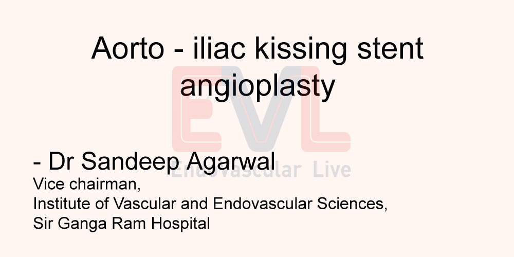 Aorto iliac kissing stent angioplasty