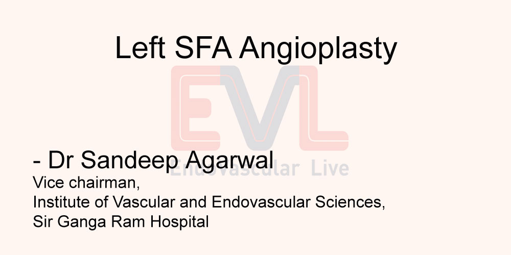 Left SFA Angioplasty