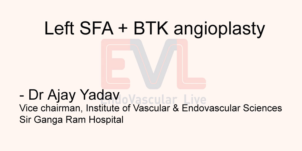 PLAN: Angiography with left SFA and BTK angioplasty via left CFA contralateral retrograde percutaneous approach under LA