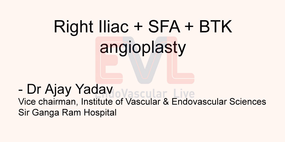 Right Iliac + SFA + BTK angioplasty