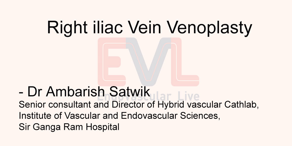 Right iliac vein venoplasty
