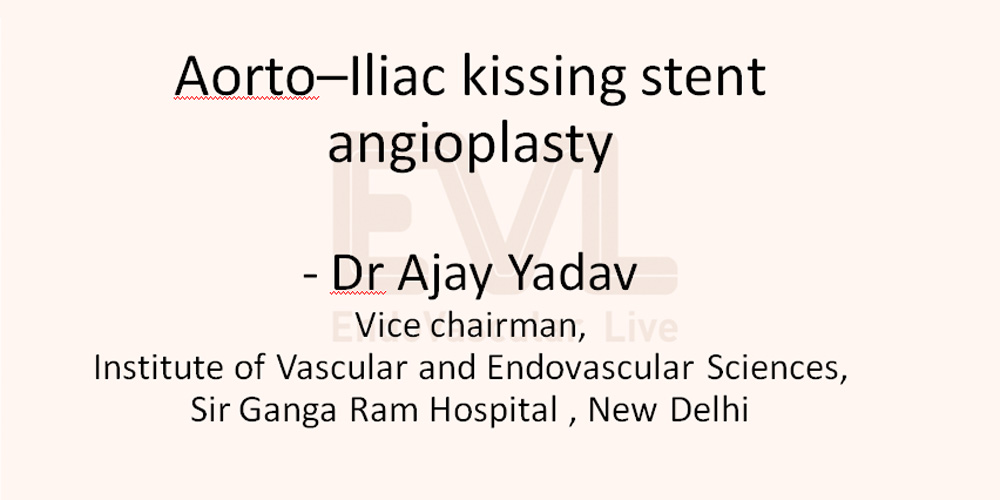 Aorto–Iliac Kissing Stent Angioplasty